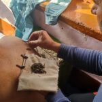Leeches on a man's back as part of leech therapy